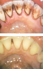 Zahnarztpraxis Dr. Schmidt - Itzehoe - Leistungen - Professionelle Zahnreinigung